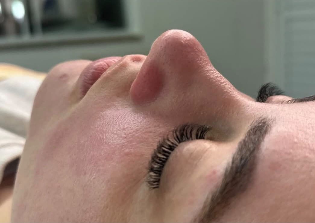 Limpeza de pele: a pele antes e depois do atendimento — depois